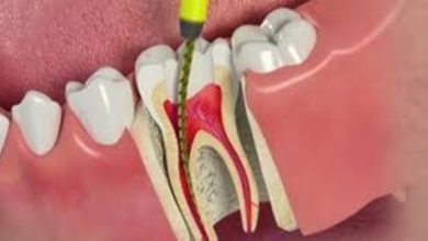 Photo of A Quick Guide to Endodontic Therapy