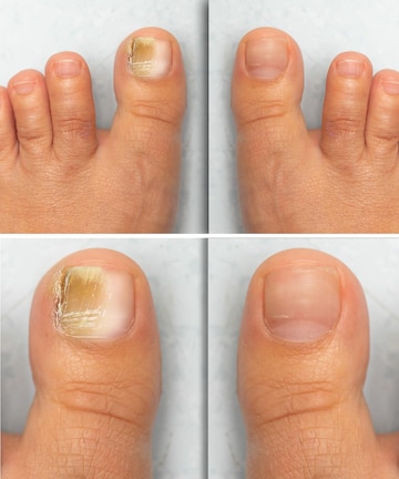 How to Treat Toenail Bacterial Infection?